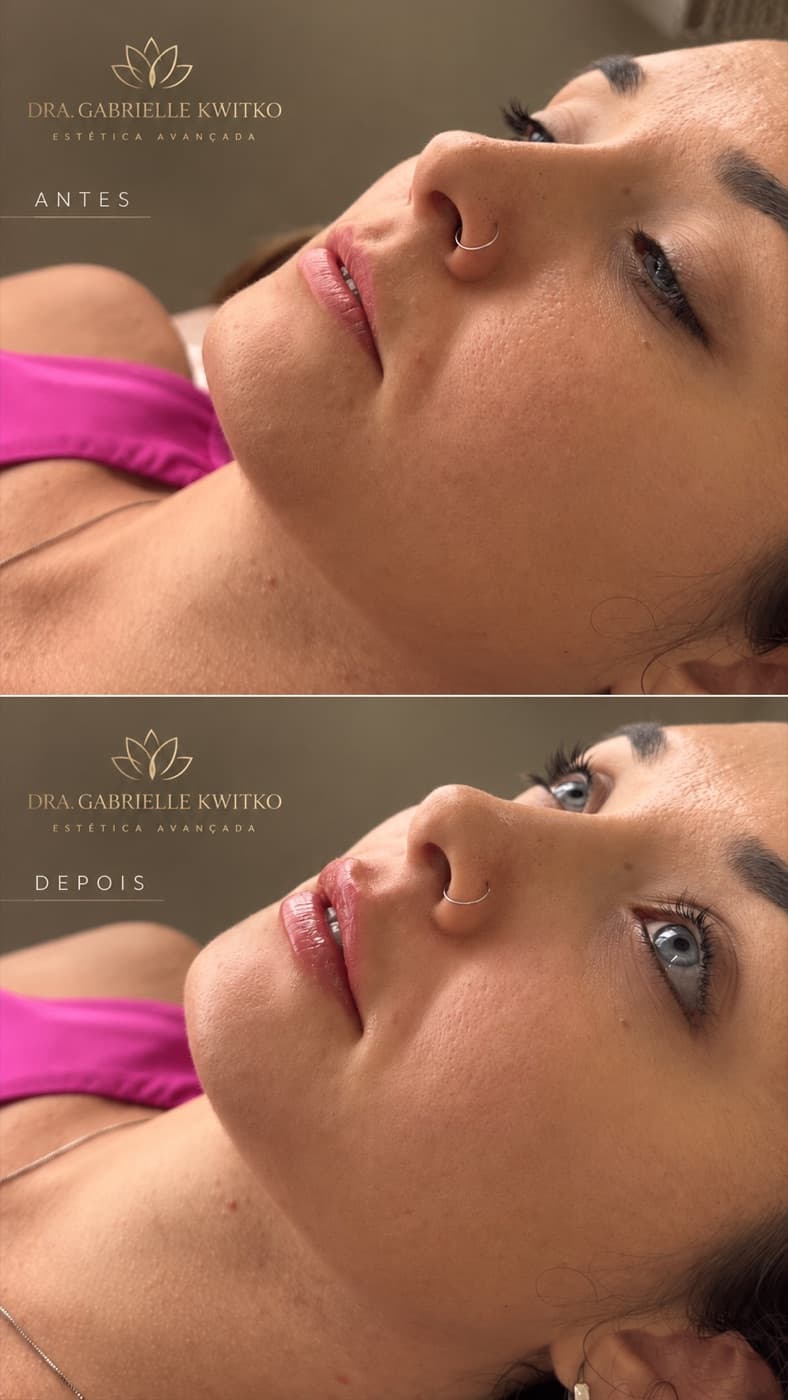 Antes e depois de preenchimento labial com ácido hialurônico, vista de perfil, em Florianópolis