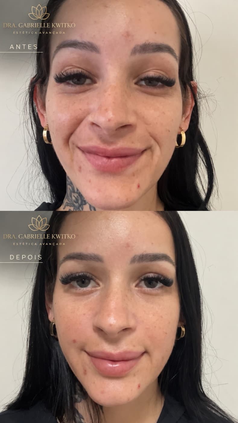 Antes e depois de preenchimento de sulco nasogeniano (bigode chinês) com ácido hialurônico em Florianópolis