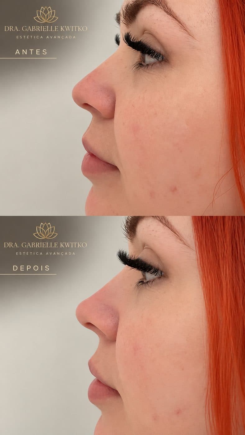 Antes e depois de rinomodelação com ácido hialurônico, sem cirurgia, em Florianópolis