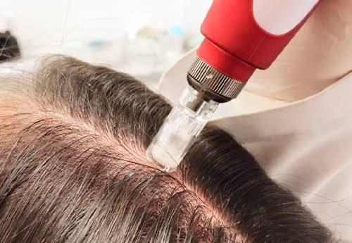 Preenchimento facial avançado na GK Estética Florianópolis - Santa Catarina: Realce de lábios, olheiras, maçãs do rosto e sulcos nasogenianos com técnicas avançadas e resultados duradouros